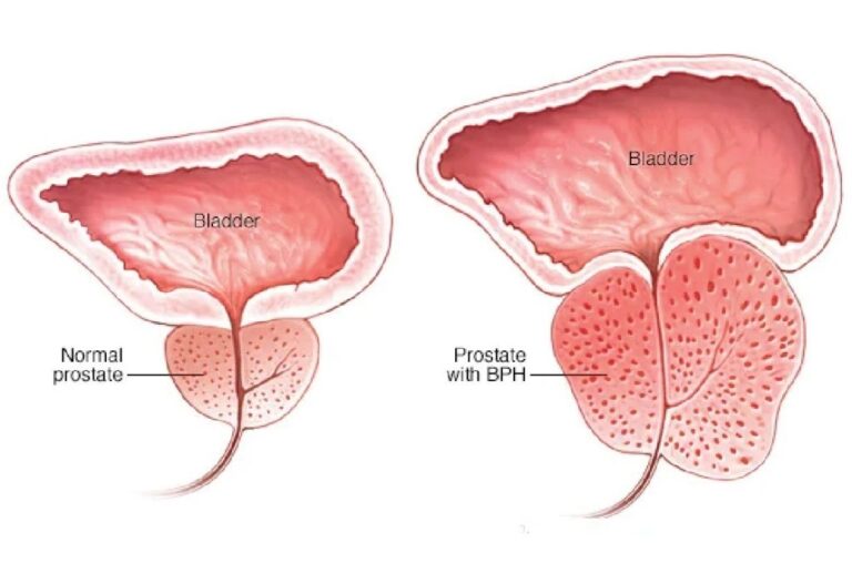 Benign Prostat Hiperplazisi Nasil Gelisir 1024X691 1