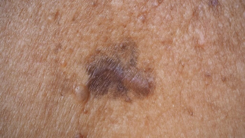 Does Skin Cancer Look Different on Black or Dark Skin? What to Watch For melanoma black skin slide2
