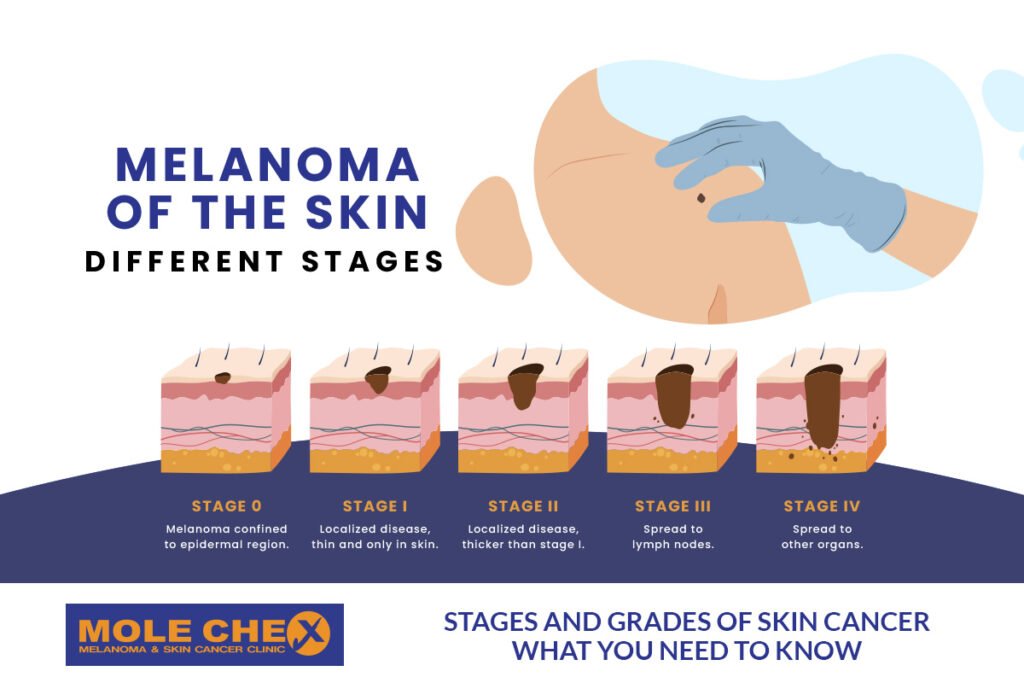 stages and grades of skin cancer what you need to know