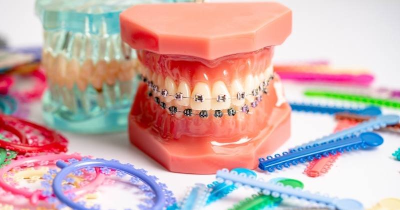 Dental Bands Improve Braces Treatment
