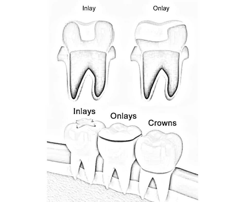 The Complete Guide to Inlays and Onlay Dental Restorations: Restoring Your Smile with Precision Dental inlays and onlays