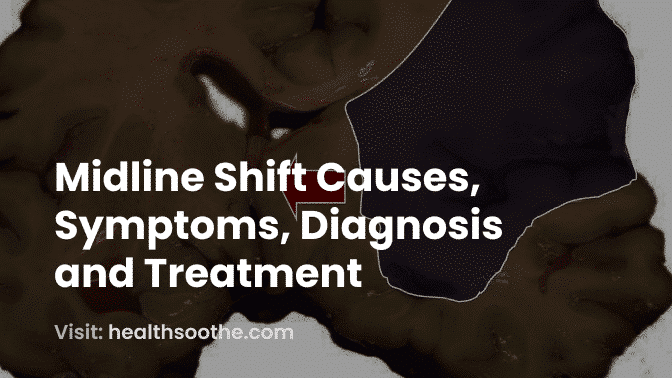 Midline Brain Shift | What You Need to Know About This Condition (with Pictures, Videos & FAQS) 2 Midline Shift Causes Symptoms Diagnosis and Treatment