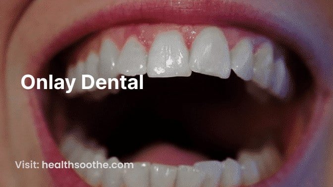 The Complete Guide to Inlays and Onlay Dental Restorations: Restoring Your Smile with Precision 1 DENTAL INLAYS AND ONLAYS TREATMENT